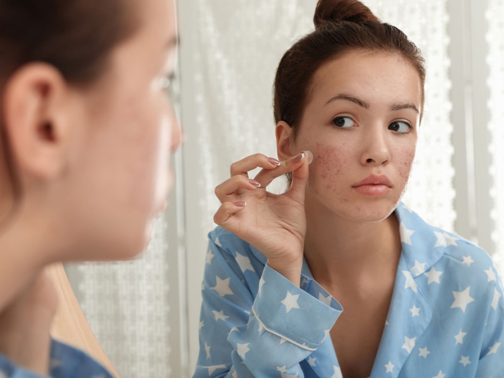 Tips to Overcome Your Stubborn Acne The Easy Way
