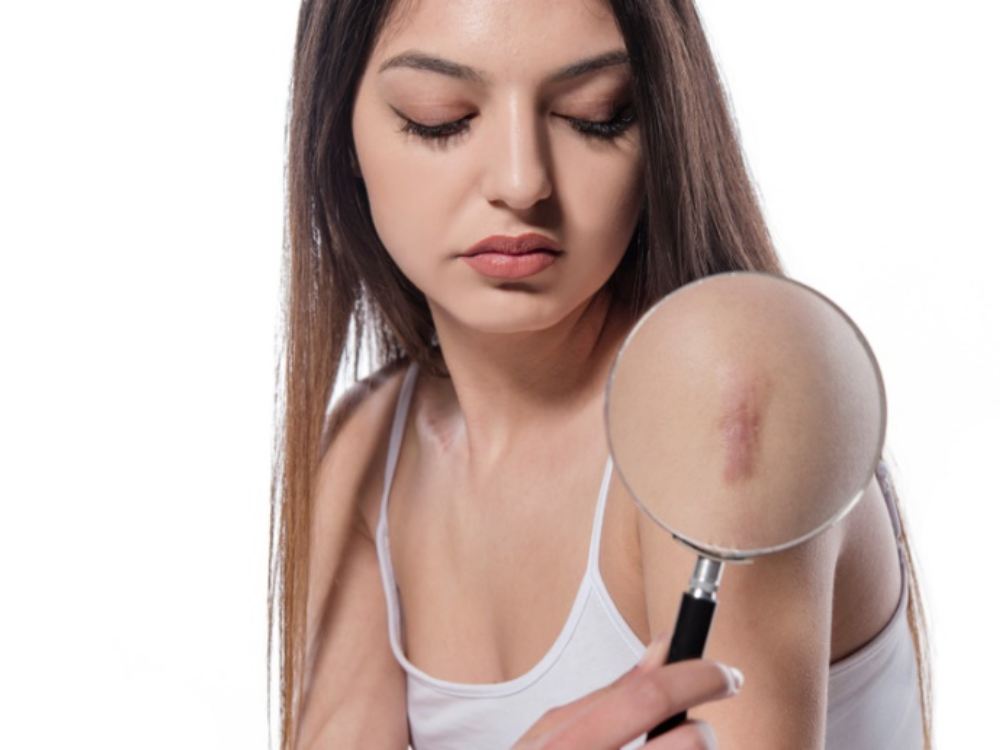 Did you hurt yourself? Donâ€™t worry! Follow the treatment steps below to minimize the scars